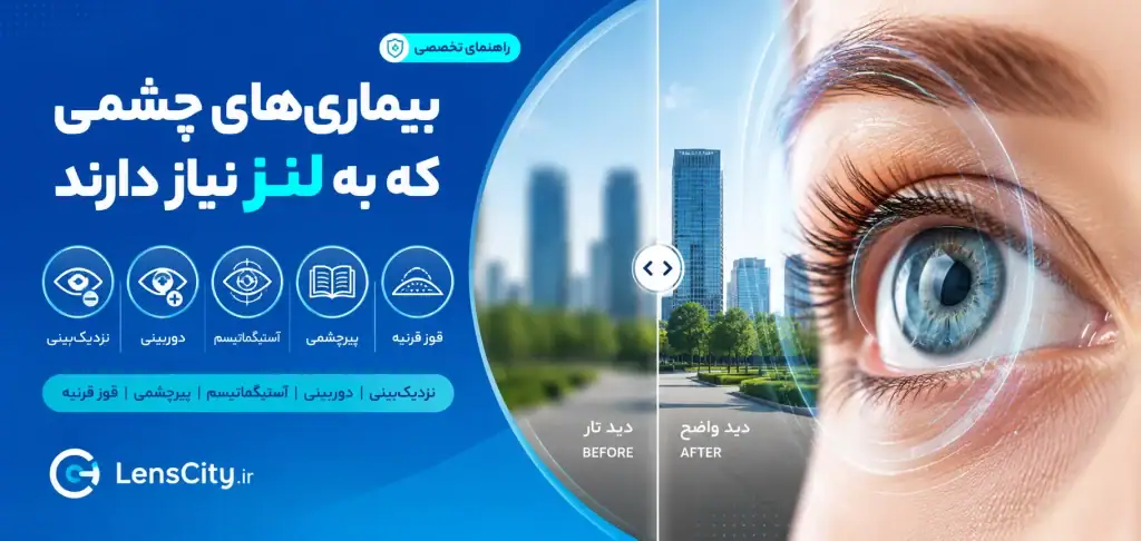 انواع بیماری های چشم که نیاز به لنز دارند